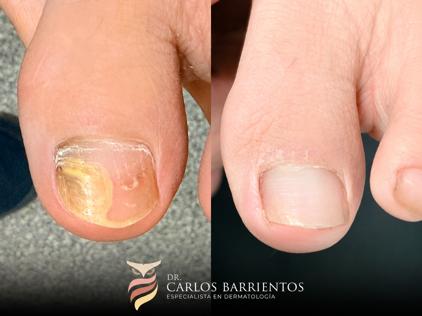 Antes y después – Onicomicosis