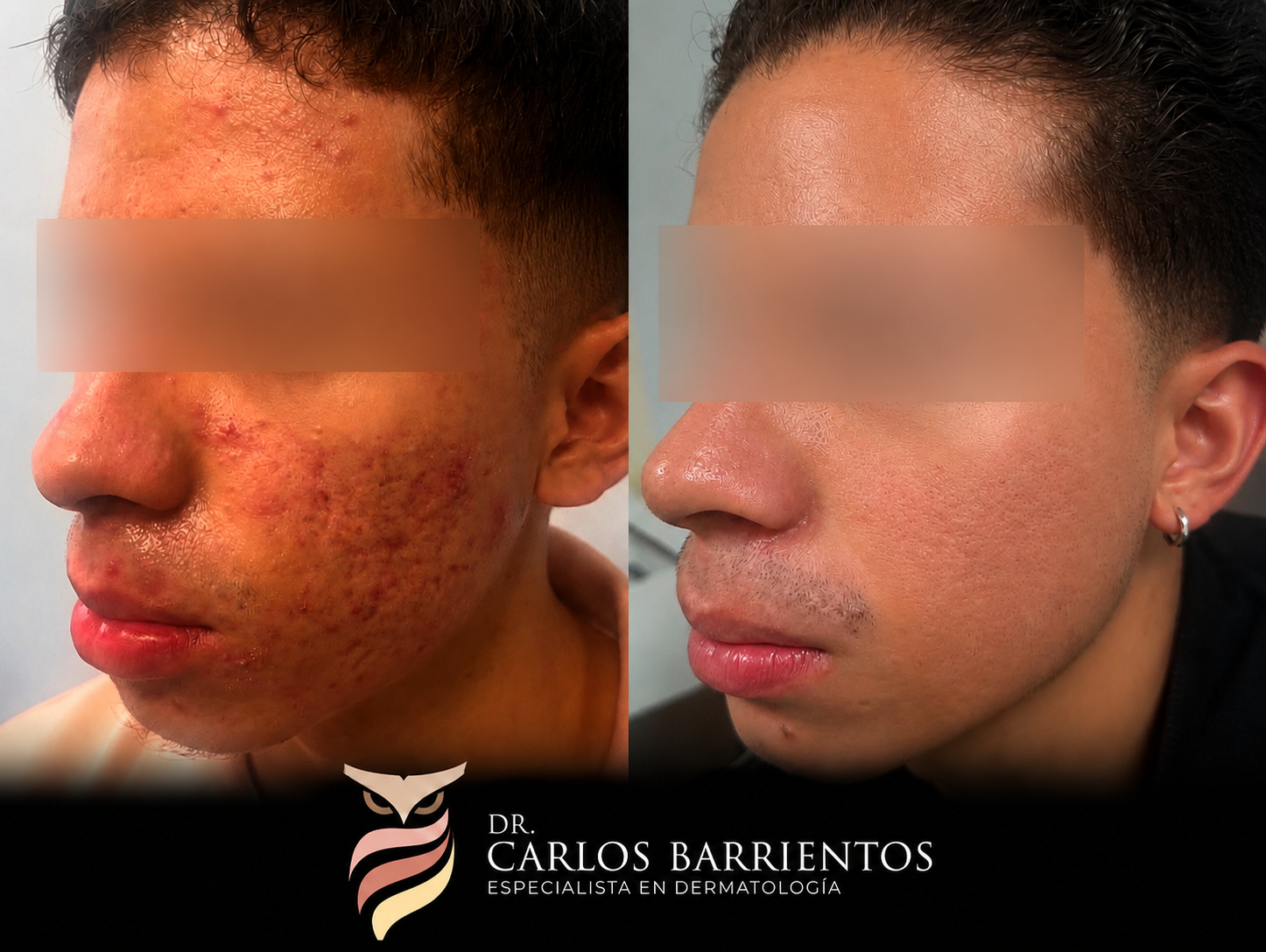 Antes y después – Acné inflamatorio
