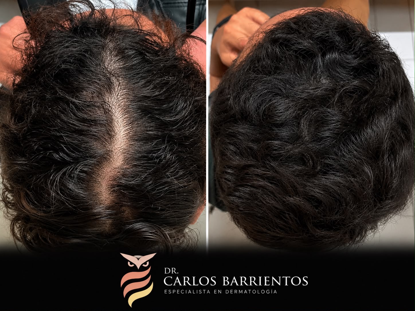 Antes y después – Recuperación de densidad